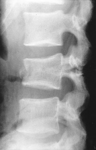 Chance Fracture (flexion-distraction injury) - Spine - Orthobullets